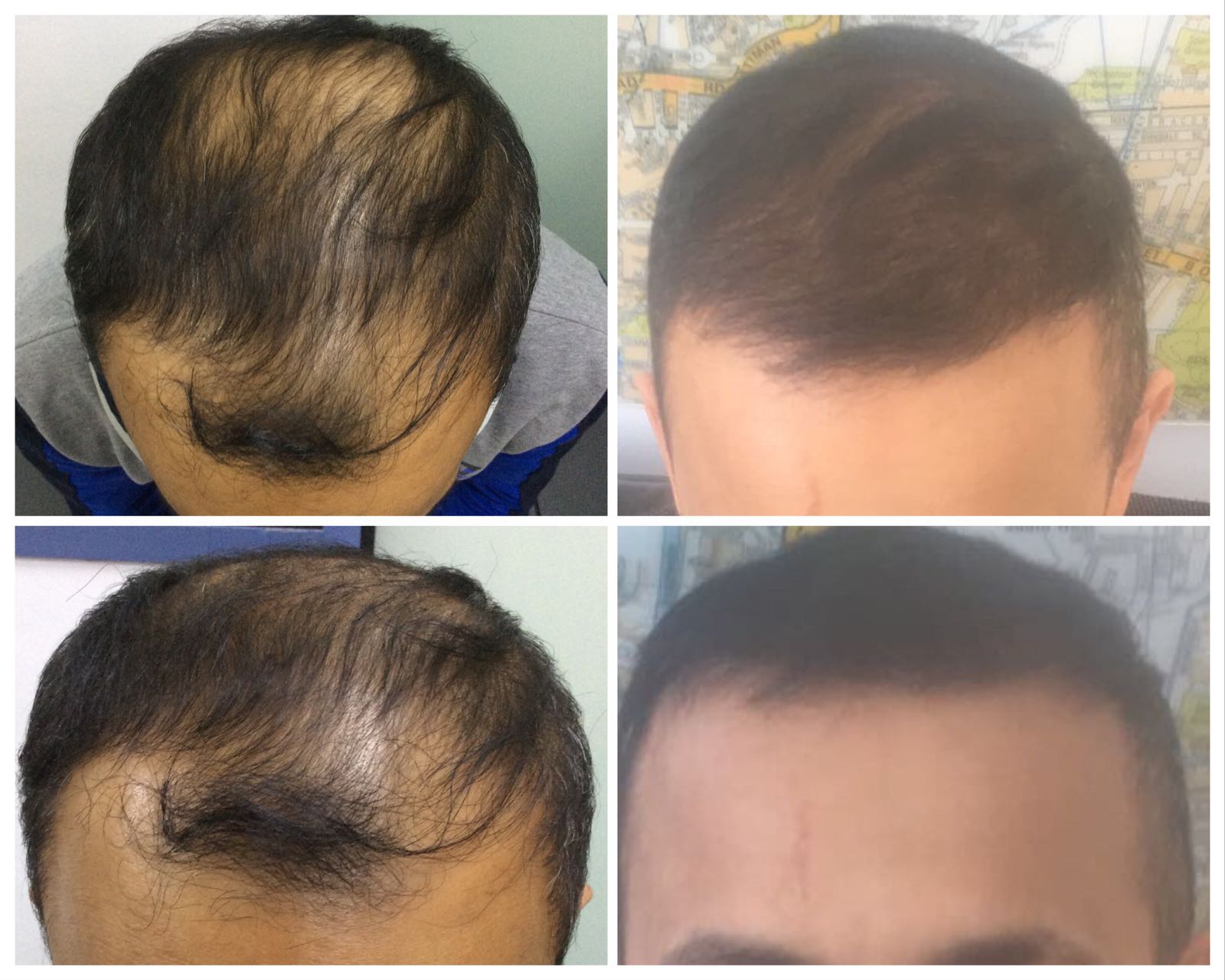 Male Hair Transplant Results Harley St Healthcare Hair
