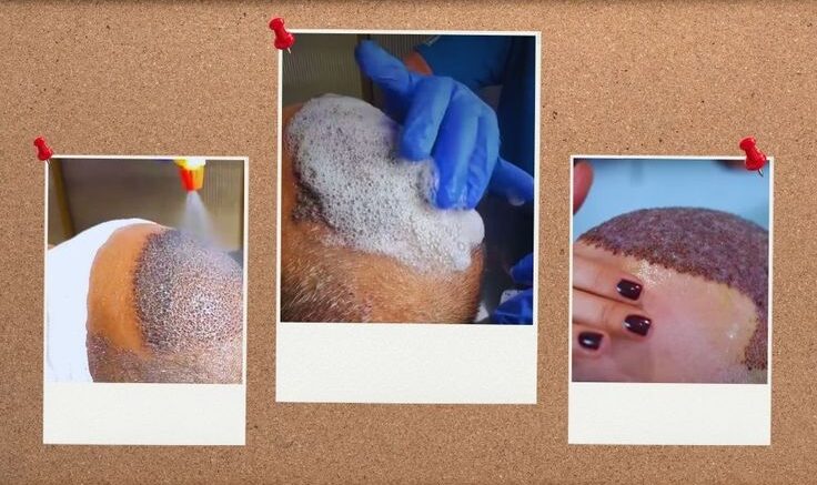 Hair Transplant in London: Post-transplant Hair Care Tips