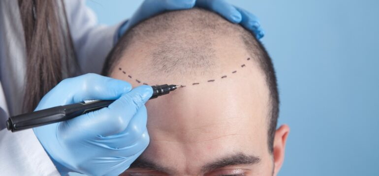 hair-transplant-in-manchester-img