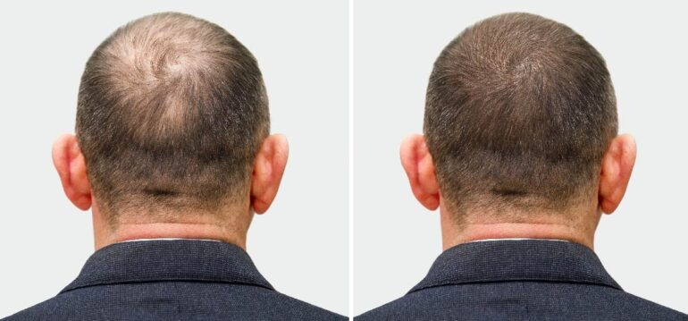 fue-hair-transplant-before-and-after-img