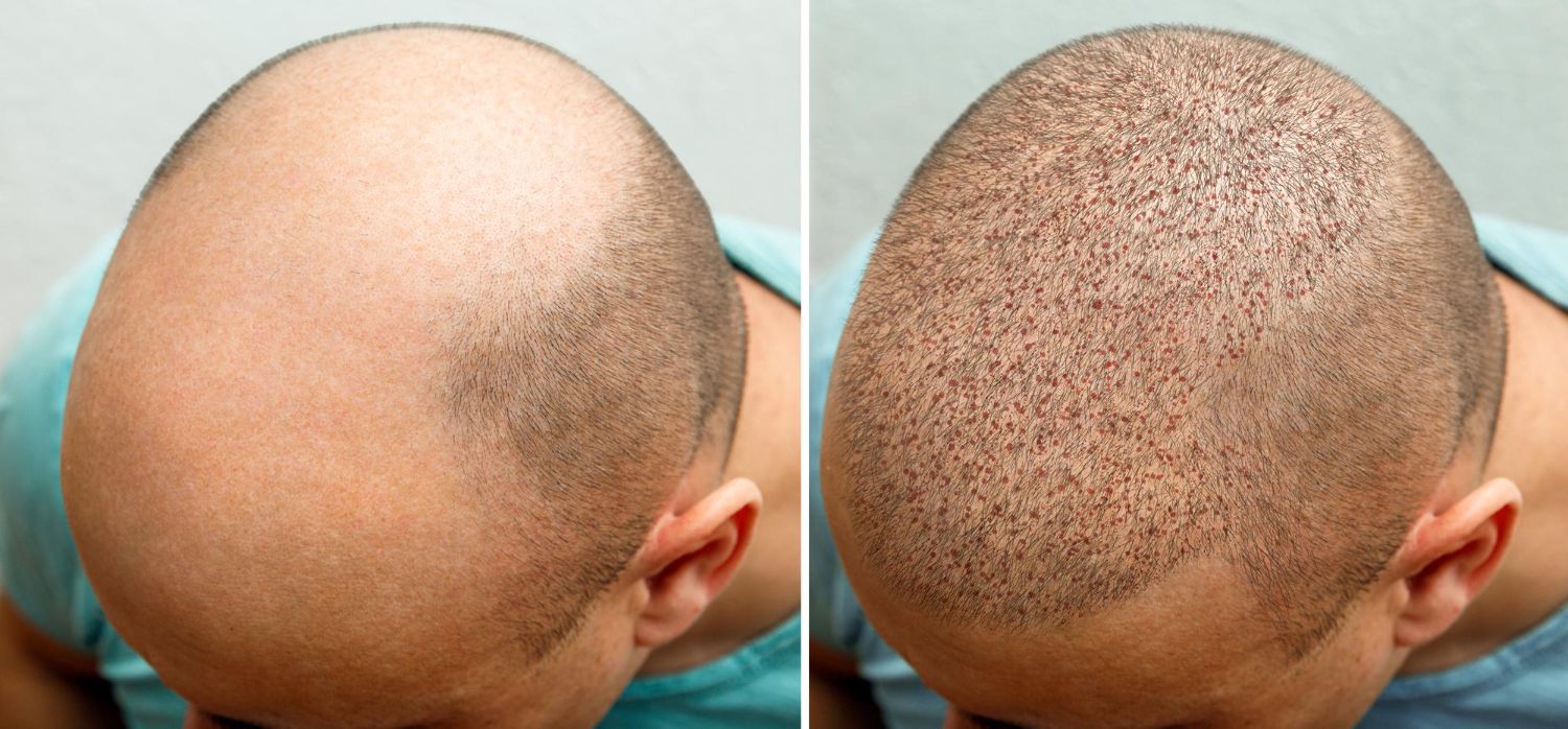 Hair Transplant Clinic in London is Bringing Back Hair on Scalp