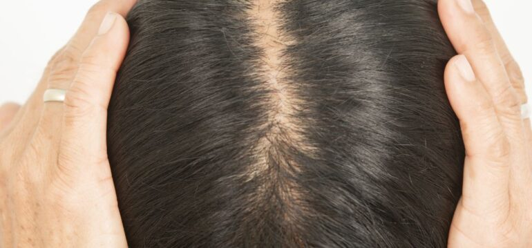 Who Is a Good Candidate for Female Hair Transplantation?