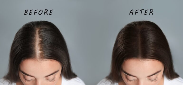 what-to-expect-during-a-female-hair-transplant-img