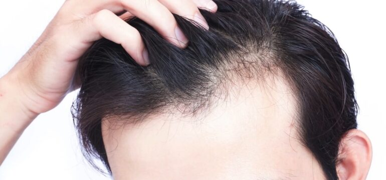 Balding in Your 20'sShould You Get a Hair Transplant?