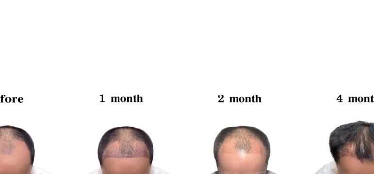 Hair Growth After Transplant  When to Expect It?