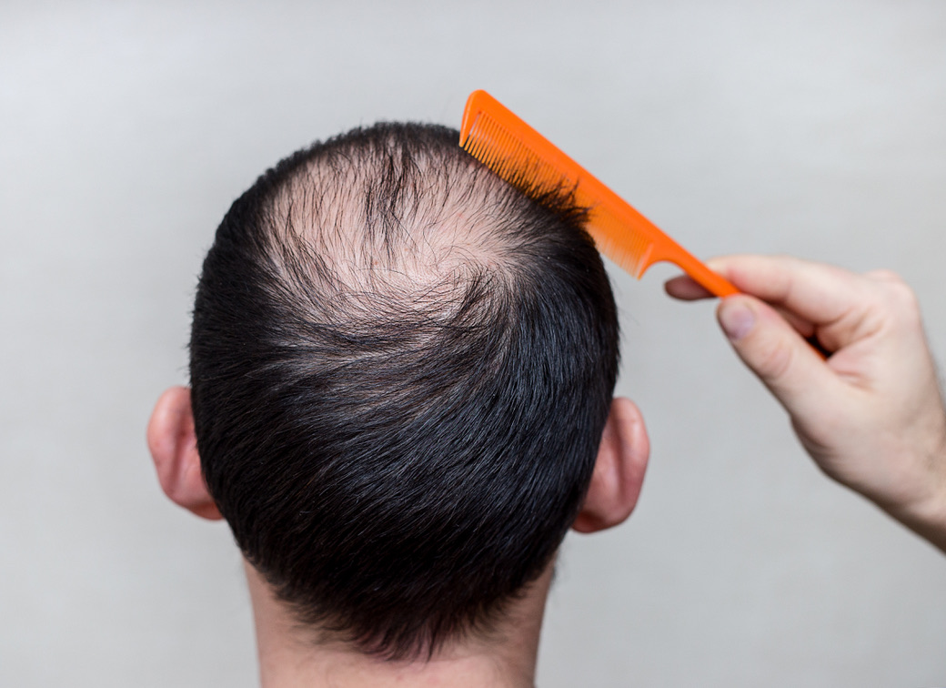 Hair Follicle Regrowth Examination For Those Experiencing Hair Loss