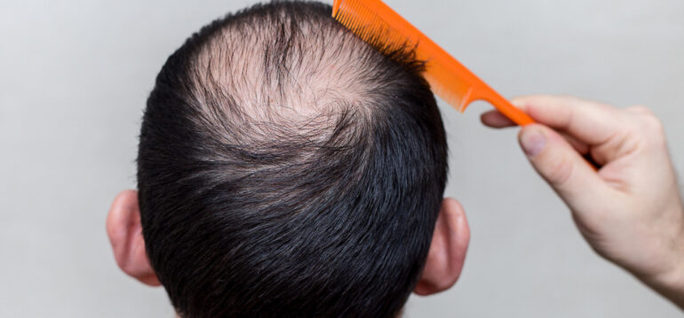 Can Hair Follicles Re-grow? An Examination for Those Experiencing Hair Loss