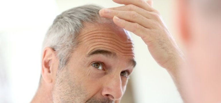 Is Your Hair-Thinning, or are you Just Being Paranoid?