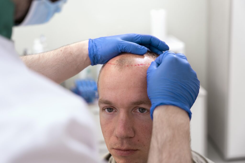 Difference Between Surgical-Vs-Non-surgical-hair-Transplant