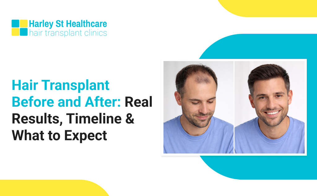 Hair Transplant Before and After Results