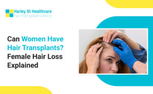 Hair loss is not just a male concern. Many women experience thinning hair, reduced density, and widening part lines at different stages of life. This raises an important question: can women have hair transplants? The answer is yes, but not in every case. Hair transplant for women requires a more personalised approach because female hair loss is often more complex than male pattern baldness.