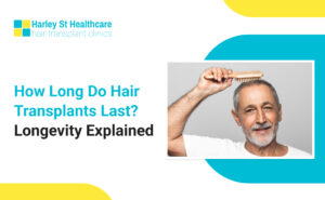 How Long Do Hair Transplants Last? Longevity Explained