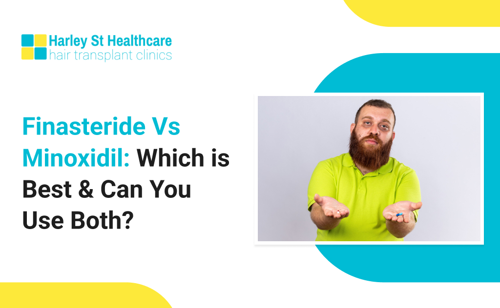 Finasteride Vs Minoxidil: Which is Best