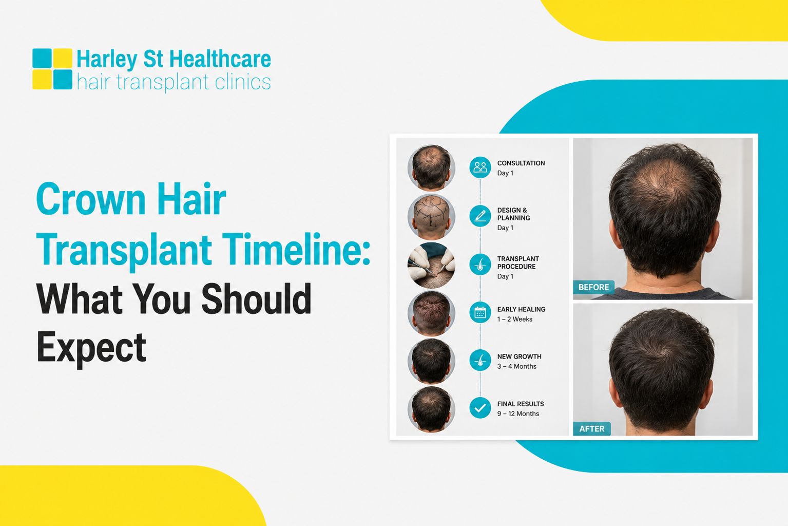 Crown Hair Transplant Timeline: What You Should Expect