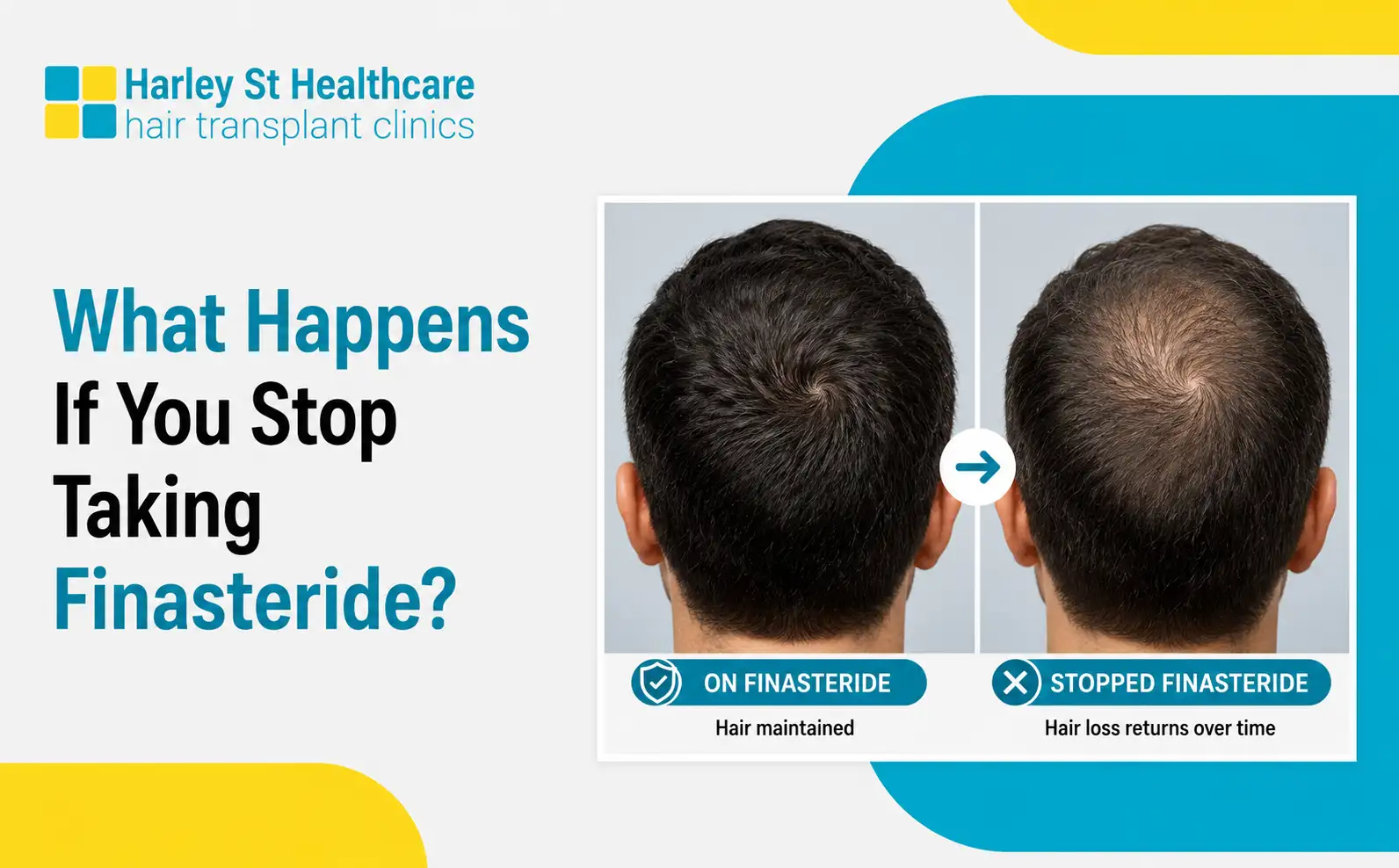 What Happens When You Stop Taking Finasteride?