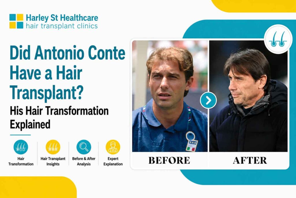 Antonio Conte Hair Transplant: Before &amp; After Transformation