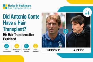 Antonio Conte Hair Transplant: Before & After Transformation