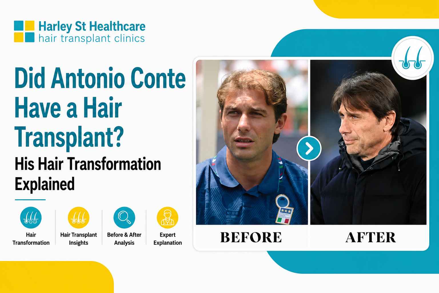 Antonio Conte Hair Transplant: Before & After Transformation
