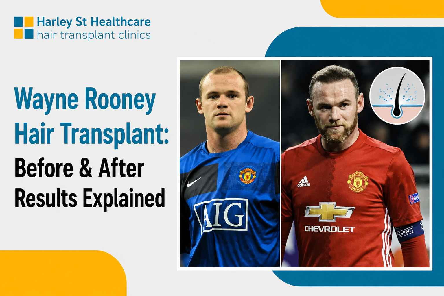Wayne Rooney Hair Transplant: Before and After Results Explained