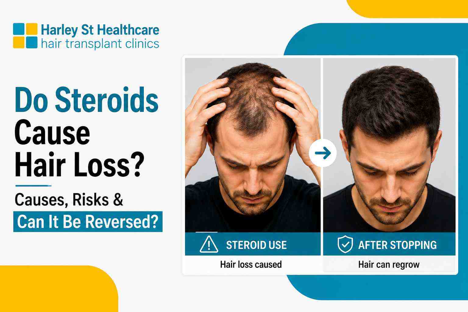 Do Steroids Cause Hair Loss?
