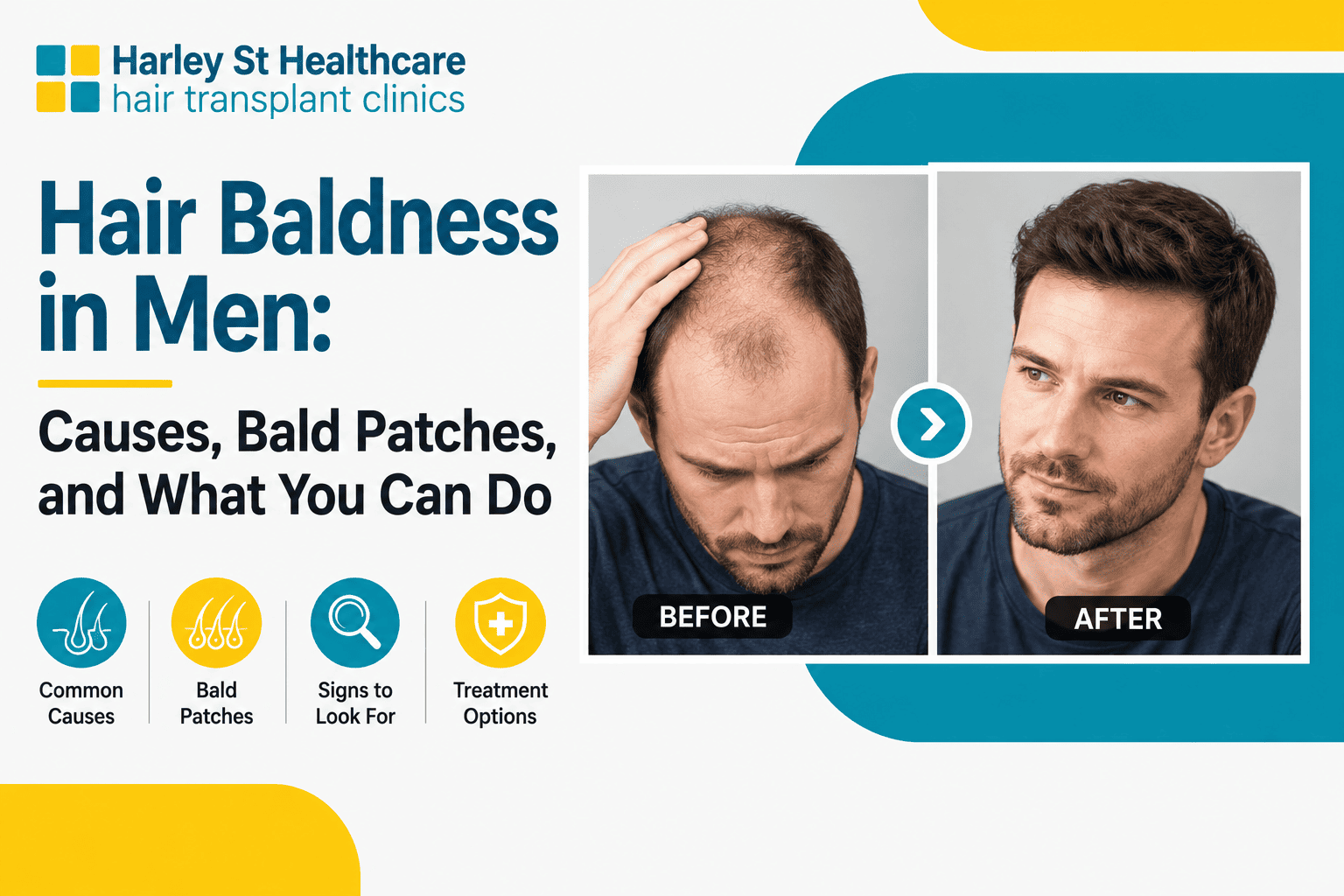 Hair Baldness in Men: Causes, Bald Patches, and What You Can Do
