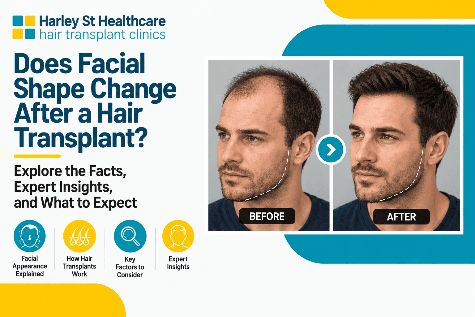 Does a Hair Transplant Change Your Face Shape